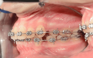 آیا برای درمان ارتودنسی نیاز به کشیدن دندان پرمولر است؟ آیا برای درمان ارتودنسی نیاز به کشیدن دندان پرمولر است؟