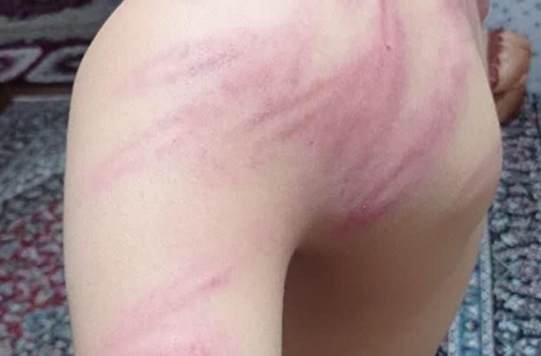 ضرب‌وشتم وحشتناک دانش‌آموزان توسط معلم به علت گم شدن شارژر موبایل/ یک دانش‌آموز در بیمارستان بستری شد/ آموزش وپرورش ناحیه ۲ سنندج: معلم خاطی مشکل روانی دارد/ حکم اخراجش از شهرستان صادر می‌شود