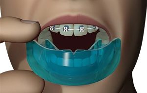 ارتودنسی و ورزش های رزمی! آیا شدنی است؟