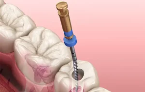 راهکارهای انتخاب بهترین متخصص درمان ریشه در شرق تهران راهکارهای انتخاب بهترین متخصص درمان ریشه در شرق تهران