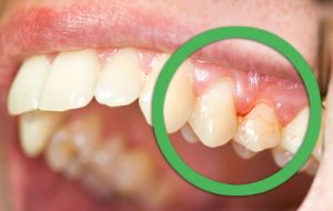 خطرات عدم درمان عفونت دندان