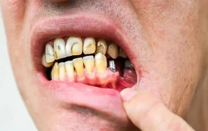 درد ایمپلنت دندان چقدر طول می‌کشد؟