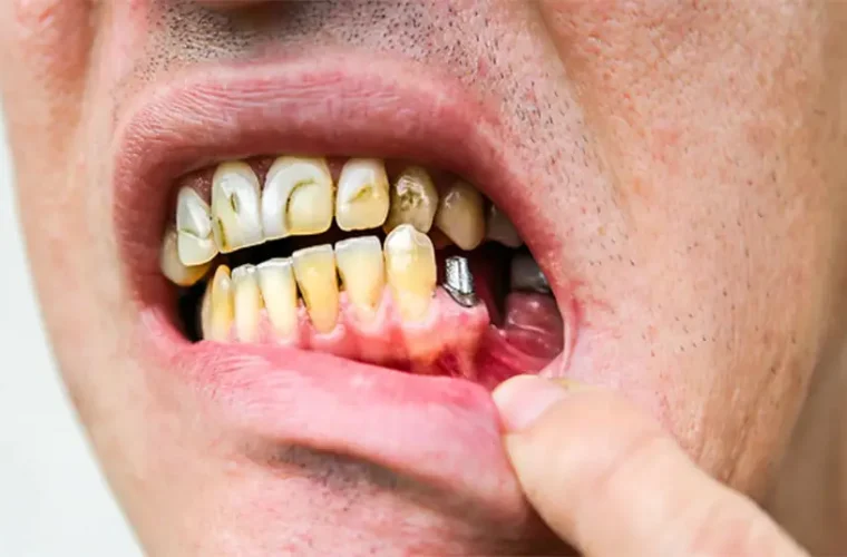 درد ایمپلنت دندان چقدر طول می‌کشد؟