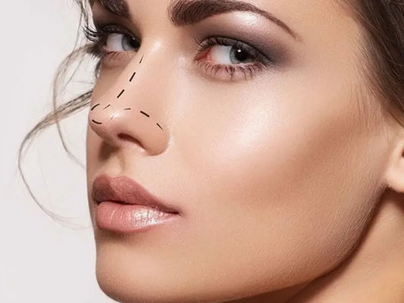 جراحی بینی طبیعی دخترانه شامل چه نکاتی است؟ جراحی بینی طبیعی دخترانه شامل چه نکاتی است؟